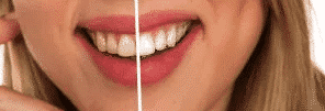 Tooth whitening - before and after
