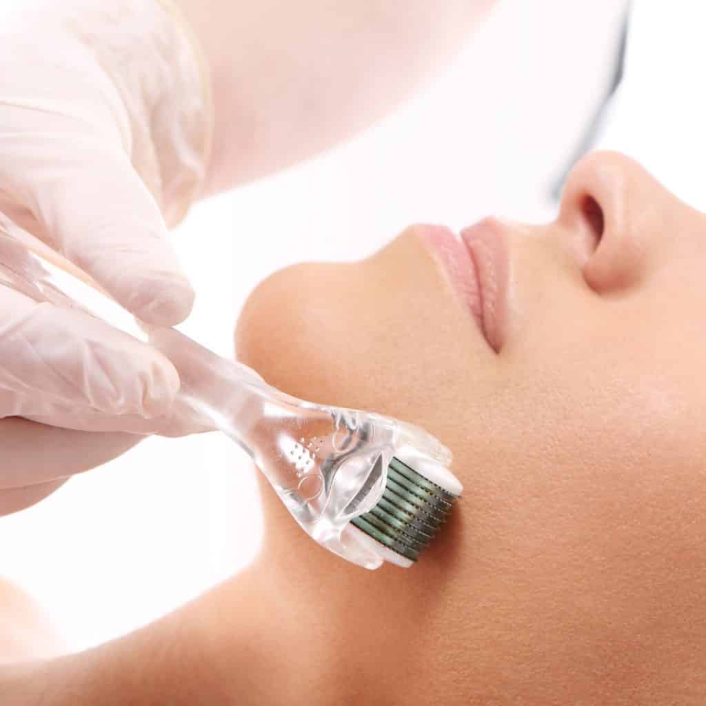 woman having Collagen Induction Therapy