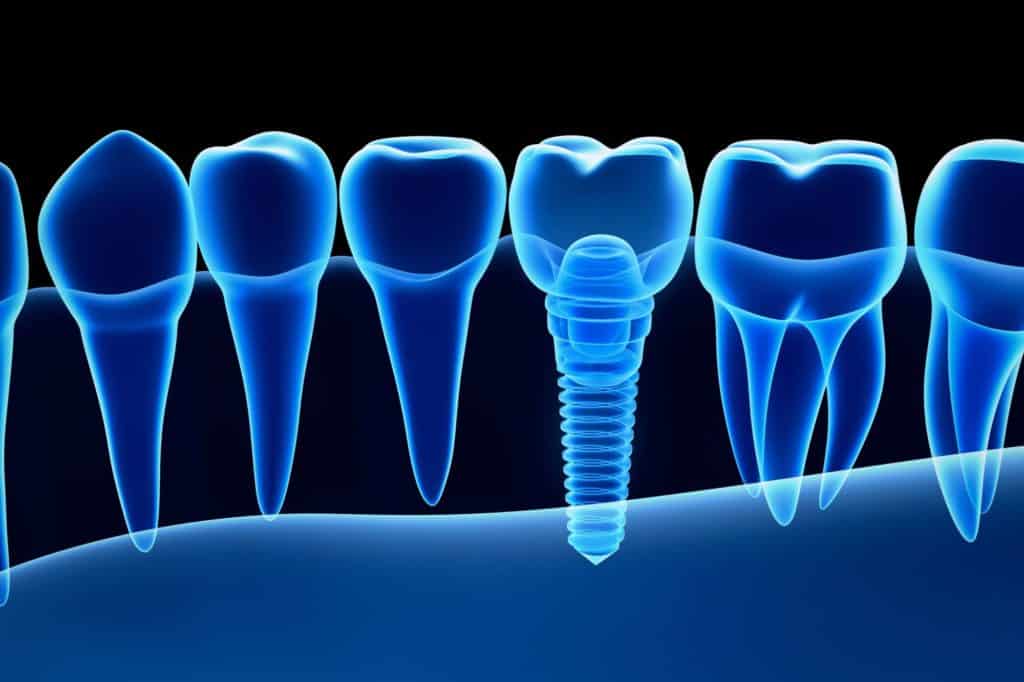 life-changing dental implant seen as an xray
