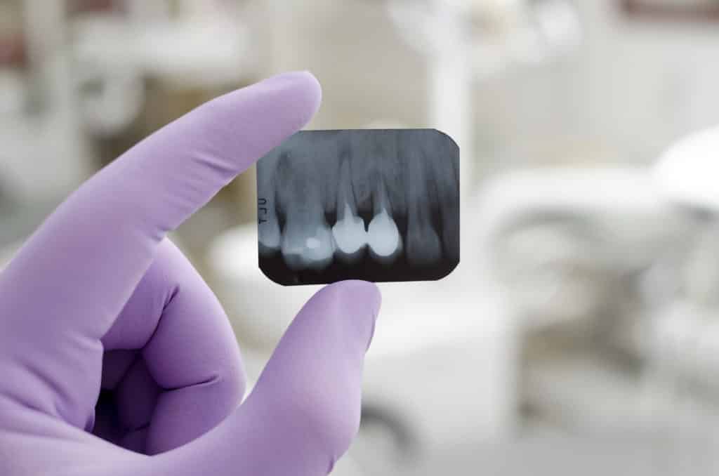 dental xray held by purlple glove